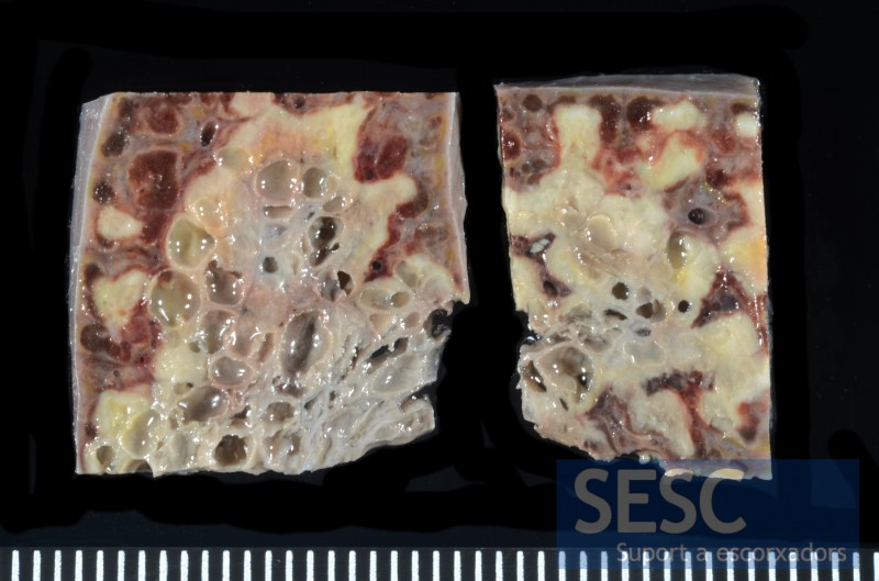Detalle de la lesión en el parénquima hepático (una vez fijado en formol): áreas rojizas, áreas blanquecinas y burbujas de gas.