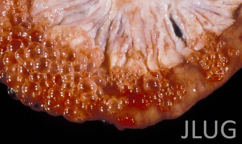 Imatge d'arxiu d'un cas típic d'emfisema intestinal