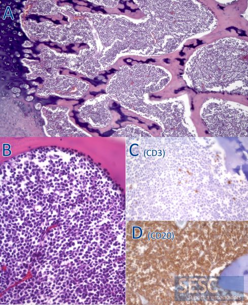 Histológicamente se aprecia una proliferación neoplásica que ocupa la totalidad de la médula ósea (A). A mayores aumentos se observa que se trata de células redondas, de origen linfoide (B) que, mediante inmunohistoquímica, se identifican mayoritariamente como células B debido a la positividad frente a CD20 (D) y negatividad frente a CD3 (C).