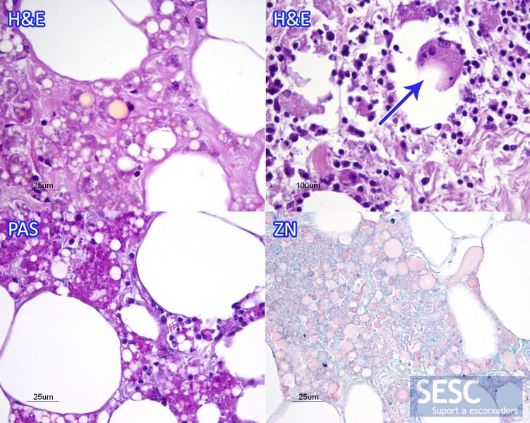 Anatomopathological study. The preparations stained with hematoxylin and eosin (H&E) allow the observation of the presence of macrophages in adipose tissue with intracytoplasmic pigment accumulation in the form of small orange spheres. In some sections there was also an overt inflammation of adipose tissue with presence of multinucleated giant cells (arrow). In this case the pigment was stained intensely with the Periodic Acid Shiff (PAS) stain that labels polysaccharides. The Ziehl Neelsen staining (ZN) stained with variable intensity the pigment accumulations.