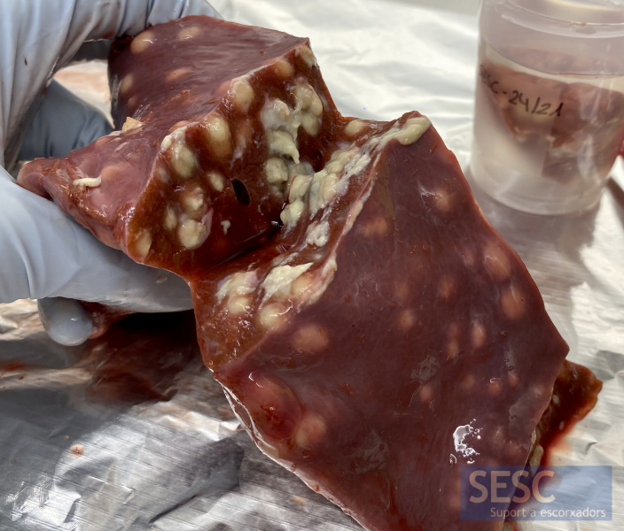 Cut Section Of The Liver Where The Hepatic Abscesses Can Be Seen