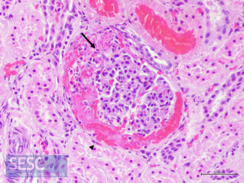 Glomerulonefritis exsudativa fibrinosa. Detall d’un glomèrul en el que s’observa fibrina i eritròcits lliures a la càpsula de Bowmann (punta de fletxa) així com necrosis segmental i presència de PMNN en els capil·lars glomerulars (fletxa).