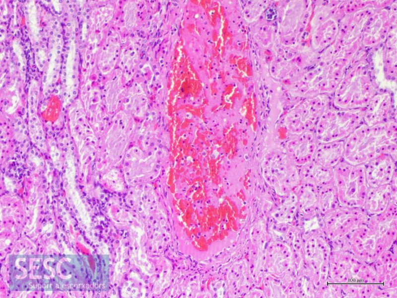 Vasculitis necrotitzant en un dels vasos renals, lesió característica del SDNP. 