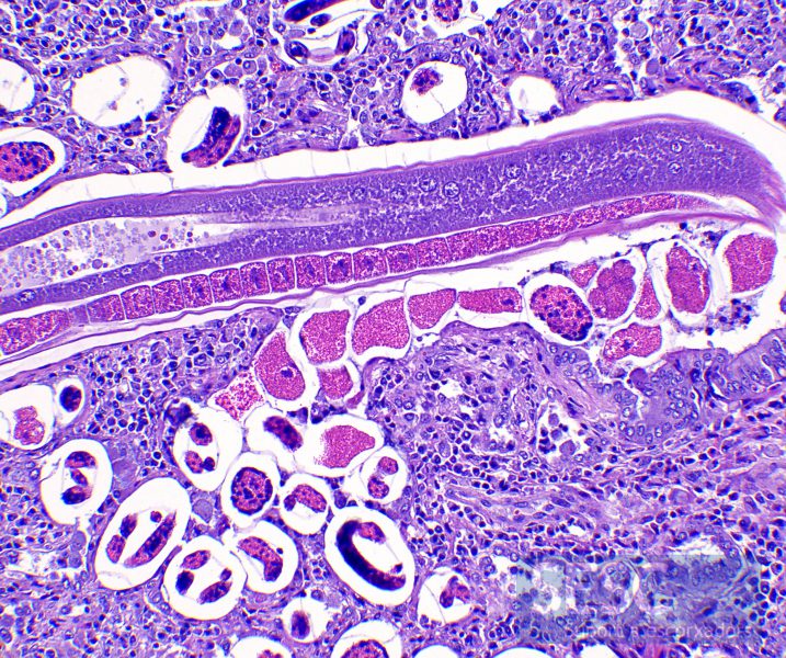 Detall de les larves parasitàries i inflamació granulomatosa.