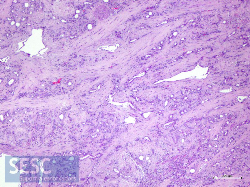 Imatge histològica (HE) del tumor adenomatoide miocàrdic. Les cèl·lules neoplàsiques epitelials formen túbuls sobre un abundant estroma fibrós. 