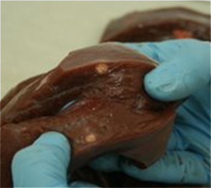 Nódulo blanquecino de tamaño más reducido, irregular, intraparenquimatoso en el hígado.