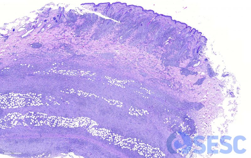 Secció histològica de nòdul cutani. Es pot observar un engruiximent de la pell degut a un engruiximent dèrmic i epidèrmic moderat, així com una marcada proliferació cel·lular i infiltrat inflamatori al subcutani. 