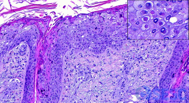 Detall de l’epidermis. Es pot observar vacuolització i tumefacció dels queratinòcits (degeneració bal·loniforme). En molts d’ells s’observa un únic cos d’inclusió intracitoplasmàtic eosinòfil (a dalt a la dreta). 