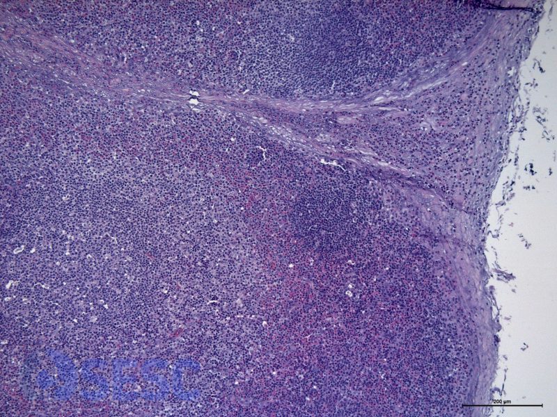 Presència d’eosinòfils en els sinus subcapsulars, envoltant els fol·licles limfoides. 