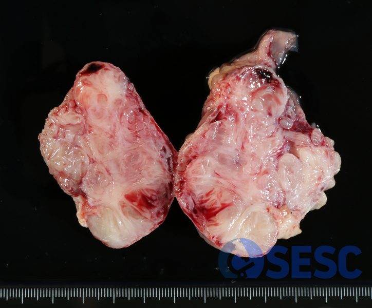Secció del tumor en el que s’observa l’aspecte fibrós, finament variegat. 