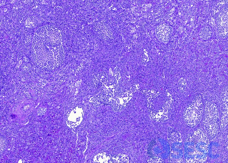 Detall histològic de l’arrenoblastoma. Es pot observar una neoplàsia heterogènia donat l’origen divers de les cèl·lules que la composen.
