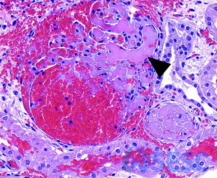 Ronyó a més augments. Es pot observar un glomèrul amb trombosi difusa dels capil·lars glomerulars i hemorràgia a la càpsula de Bowman. 