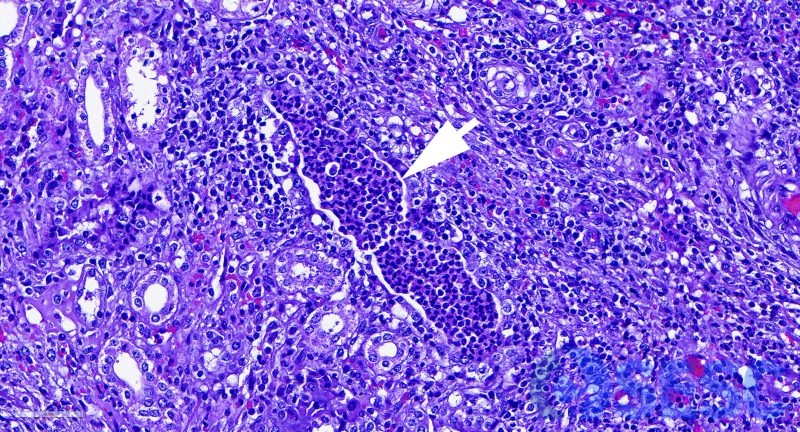 Histològicament es va confirmar la presència de pielonefritis, observant-se grans acúmuls de neutròfils als túbuls renals (Fletxa). 