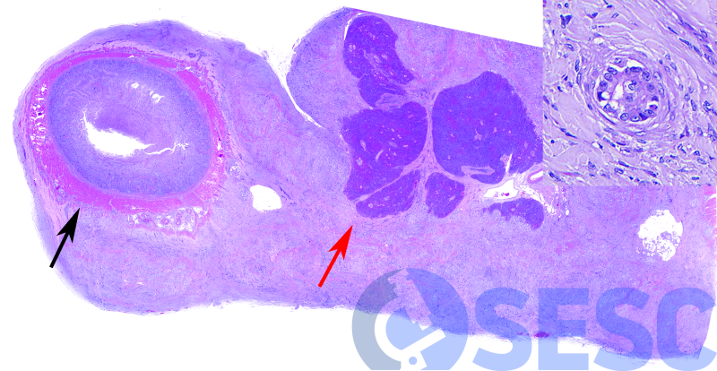 A la histologia del duodè-pàncrees s’observa com aquesta neoplàsia s’ha disseminat per sembra a la cavitat celòmica (carcinomatosi celòmica), afectant la serosa del intestí (fletxa negra) i pàncreas fletxa vermella). A més augments (inset) es poden observar cèl·lules neoplàsiques formant túbuls i acinis, d’origen epitelial, confirmant que es tracta d’un adenocarcinoma ovàric. A més, també es pot observar molt abundant teixit fibrós madur entre les cèl·lules neoplàsiques (desmoplasia fibrosa), una troballa habitual en aquests tumors. 