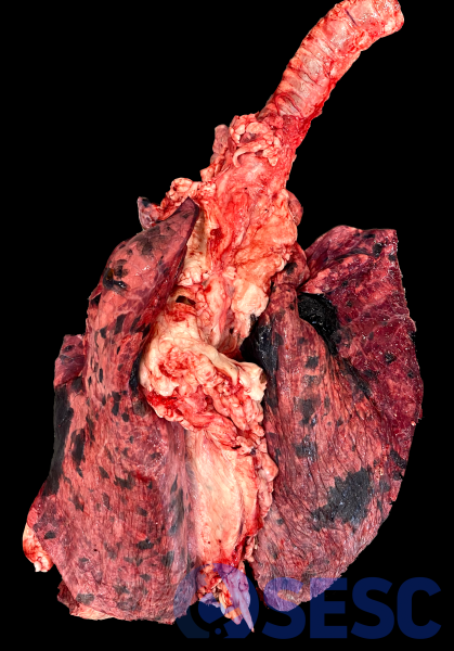 Pulmó de boví. En aquest pulmó de boví es poden observar àrees multifocals generalitzades de coloració molt enfosquida. Al tall, aprofundien molt al parènquima pulmonar adjacent. 