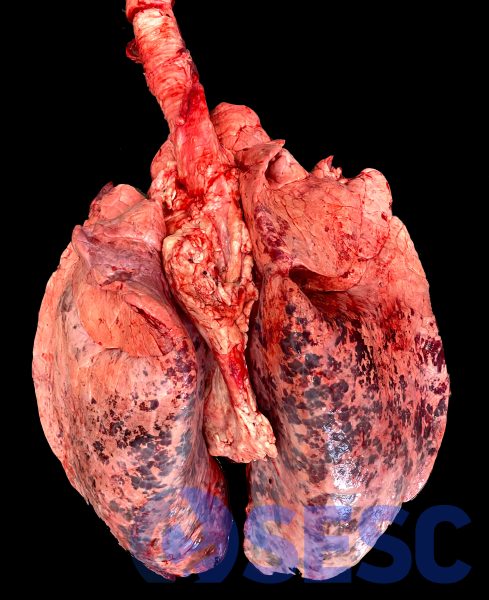 Pulmons de boví. Novament trobem alteracions incidentals post-mortem en pulmons de boví amb poca rellevància patològica. En aquest cas veiem àrees multifocals envermellides generalitzades sobre el pulmó; molt més acusades al cantell dorsal dels pulmons diafragmàtics. 