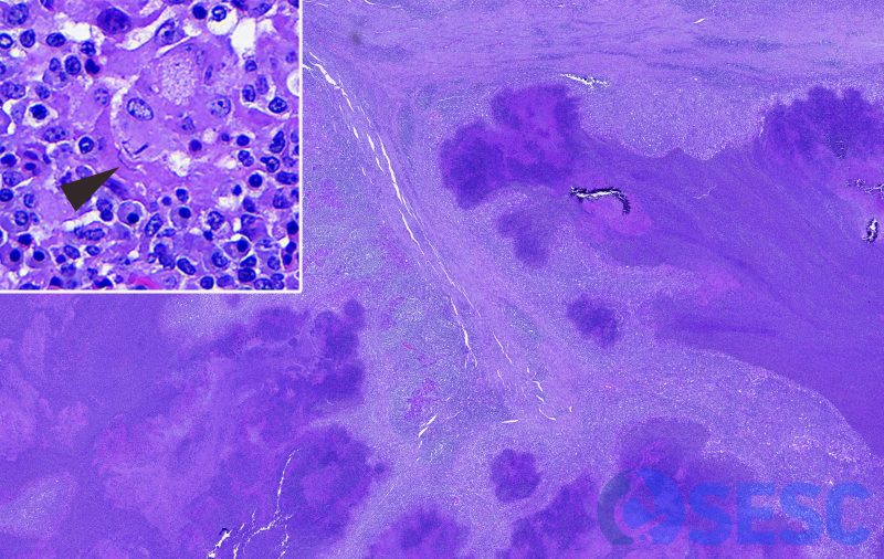 Histològicament es pot observar el teixit pulmonar substituït en la seva pràctica totalitat per acúmuls irregulars de neutròfils viables i necròtics, delimitats per abundants macròfags, cèl·lules gegants multinucleades i teixit de granulació i fibrós; que s’acompanya d’abundant inflamació mononuclear. A més, en aquesta pneumònia piogranulomatosa focal, es poden observar bacils en el citoplasma de cèl·lules gegants multinucleades, ocasionalment encadenats (bacteris filamentosos; probablement Nocardia spp.). Per tant, aquesta lesió no es corresponia amb tuberculosi. 