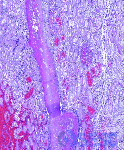 S’observen abundants vasos trombosats, especialment les artèries arcuates i radials (seguint la marca hemorràgica). 
