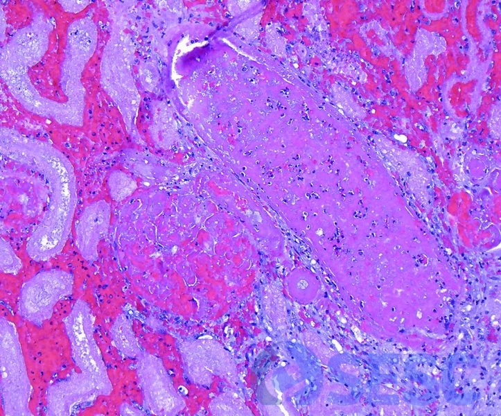 Detall histològic d’un vas trombosat, així com d’un glomèrul que presenta trombosi difusa dels capil·lars glomerulars. 