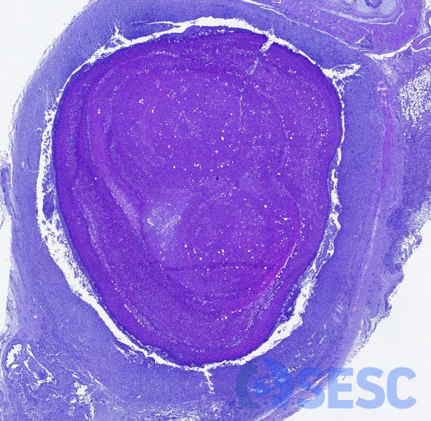 Imatge histològica a pocs augments d’un dels granulomes. Es pot observar un gran centre necròtic envoltat d’una banda de macròfags i teixit fibrós madur. 