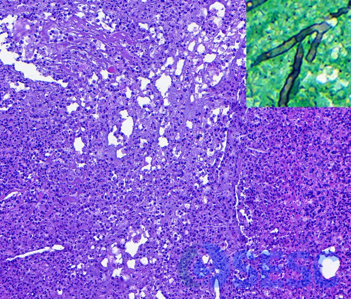 Detall del centre del granuloma, on abundants restes cel·lulars i heteròfils degenerats es troben al voltant de múltiples hifes fúngiques. Són més evidents a la tinció de Grocott (inset). 