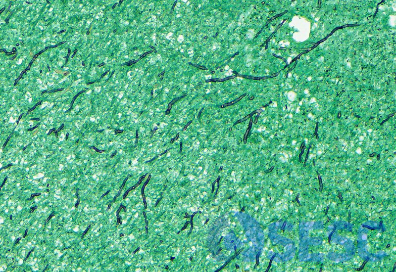 Tinció de Grocott a pocs augments, on s’observen abundants hifes fúngiques septades, amb paret paral·lela i ramificació dicotòmica (compatibles amb ascomicets). 