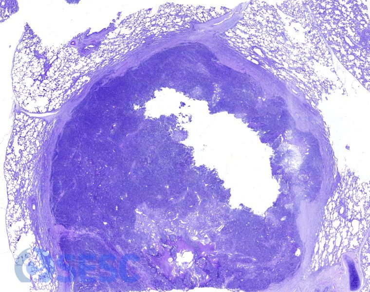 Imatge histològica d’una de les masses a pocs augments. S’observa una neoplàsia densament cel·lular que es troba ben demarcada del teixit pulmonar adjacent per una càpsula de teixit fibrós. 