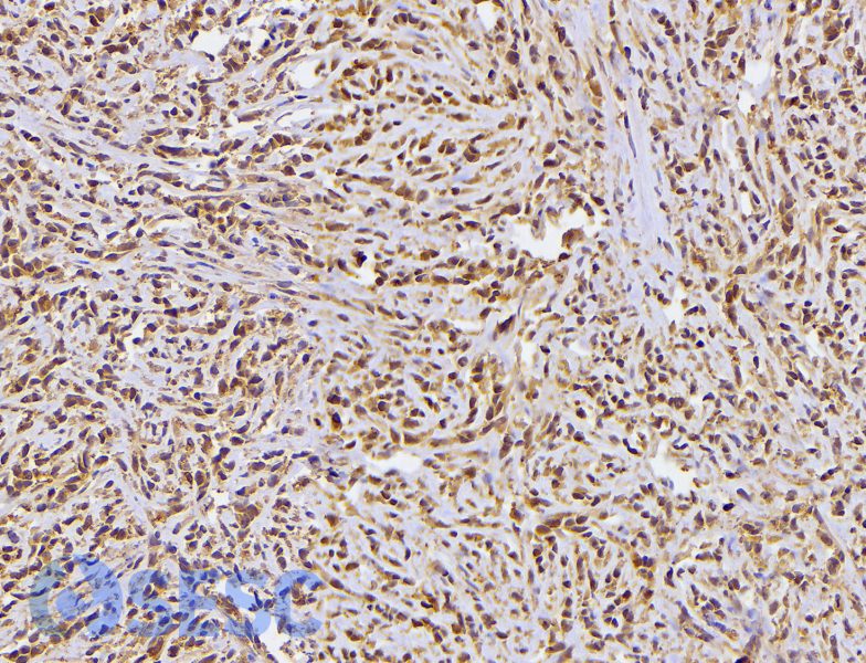 Tinció immunohistoquímica de la neoplàsia front a S100, revelant que la majoria de cèl·lules neoplàsiques són positives a aquest marcador. Això confirma el seu origen en cèl·lules del sistema nerviós perifèric. 