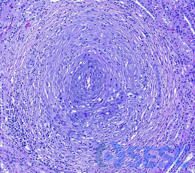 Una de les artèries, on es pot observar una marcada expansió de totes les túniques (hiperplàsia – hipertrofia), amb proliferació de vasa vasorum, vacuolització de les cèl·lules de múscul llis, fibrosis de la túnica adventícia, i infiltrats inflamatoris mononuclears. 