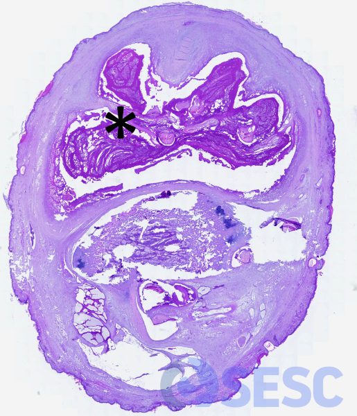 Imatge histològica a pocs augments de l’articulació anterior, on s’observa la marcada distensió de la càpsula articular per el cúmul d’exsudat, que envolta el tendó gastrocnemi. 