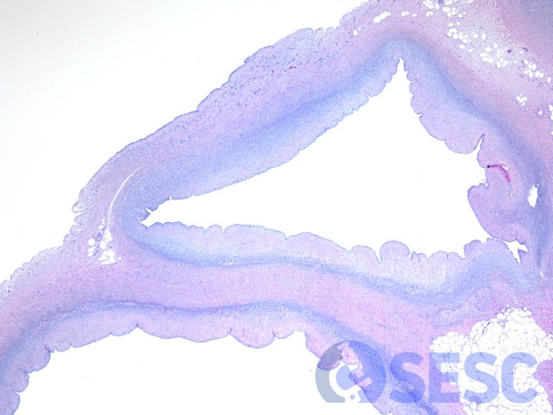 Imatge histològica a pocs augments, en què s'observen proliferacions vasculars desorganitzades i anastomosades, de llums irregulars sense presència de sang, separades per teixit connectiu i miocardi. Hematoxilina-eosina (HE)