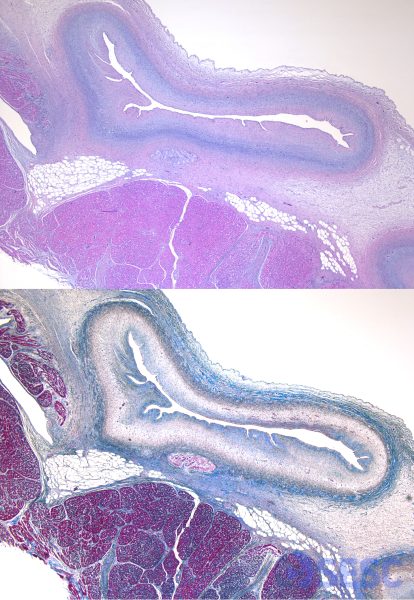 Els vasos proliferants presenten una capa interna de col·lagen lax (tinció blava), desorganitzada entremesclada amb fibres d'elastina i una capa externa de col·lagen més dens. Les fibres musculars adquireixen una coloració rosa intensa. Hematoxilina-eosina (HE) (Fig. 1), Tricròmic de Masson (Fig. 2)