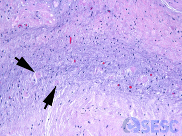 A majors augments, a la paret d’aquestes estructures vasculars, es poden observar cardiomiòcits (fletxa negra) entremesclats amb teixit fibrós i adipòcits.