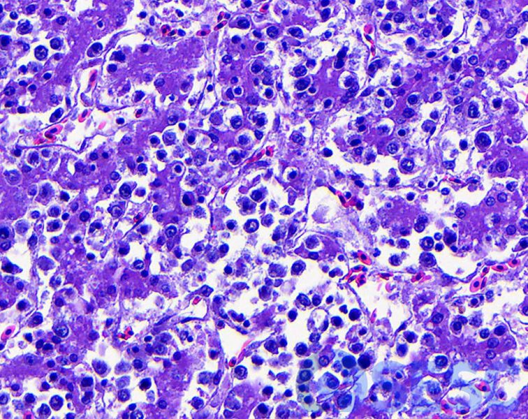 Histología del fetge. S’observen abundants limfòcits de gran mida expandint els sinusoides hepàtics. 