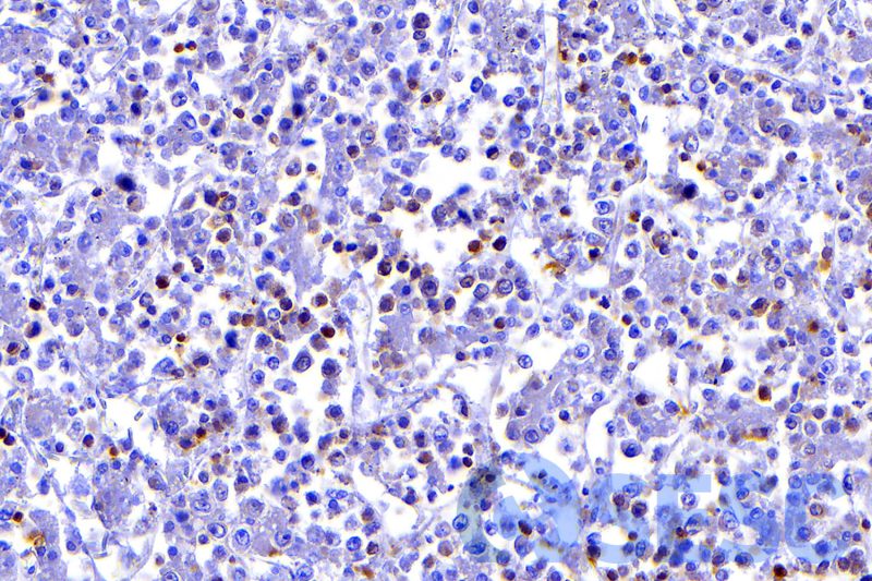 La tinció immunohistoquímica enfront CD3 confirma que les cèl·lules neoplàsiques consisteixen en limfocits T. 