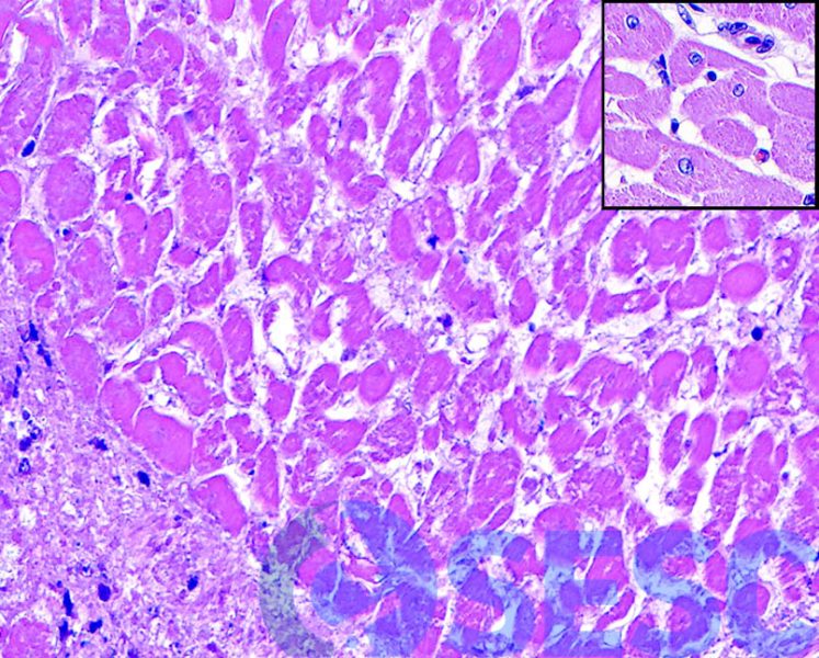 Detall del teixit necròtic, on s’evidencia una pèrdua de nuclis dels cardiomiòcits, especialment evident al comparar amb el teixit adjacent a la lesió (insert). 