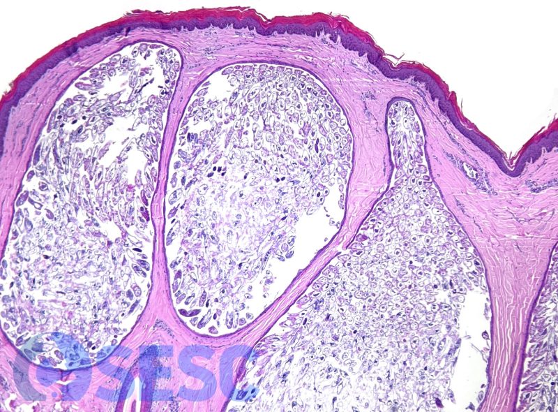 Aspect històlògic dels fol·licles pilosos dilatats amb abundants àcars del gènere Demodex al seu interior.