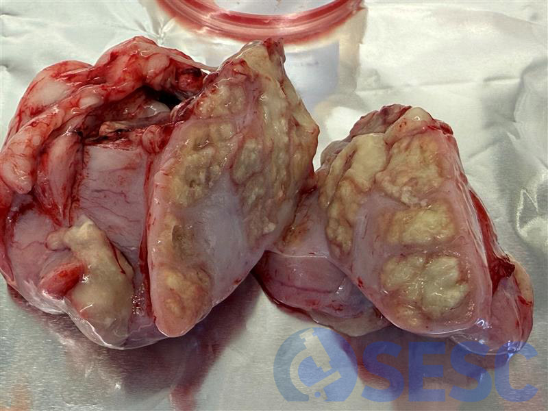 Lesió granulomatosa crònica, encapsulada al parènquima pulmonar.