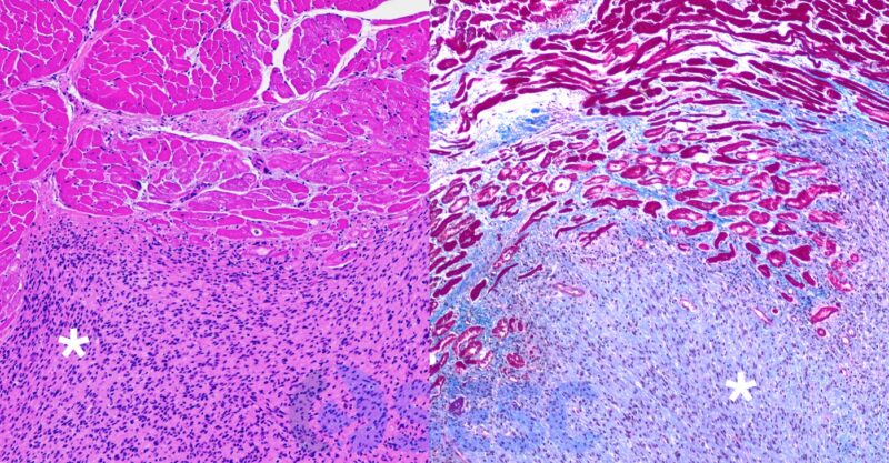 Imatge microscòpica de la lesió. A l'esquerra amb la tinció d'hematoxil·lina eosina es veu la proliferació neoplàsica fusiforme (asterisc) que infiltra les fibres musculars que s'observen a la part superior. A la dreta la tinció tricròmoica de Masson evidencia l'estroma ric en col·lagen (color blau) de la proliferació.