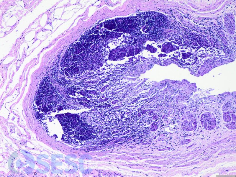 Gastric mucosa with lymphoid cell clusters.